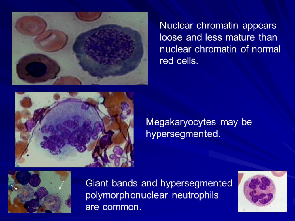 Nuclear chromatin appears loose and less mature than nuclear chromatin of normal red cells.